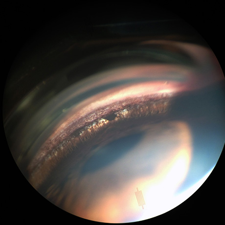Gonioscopia